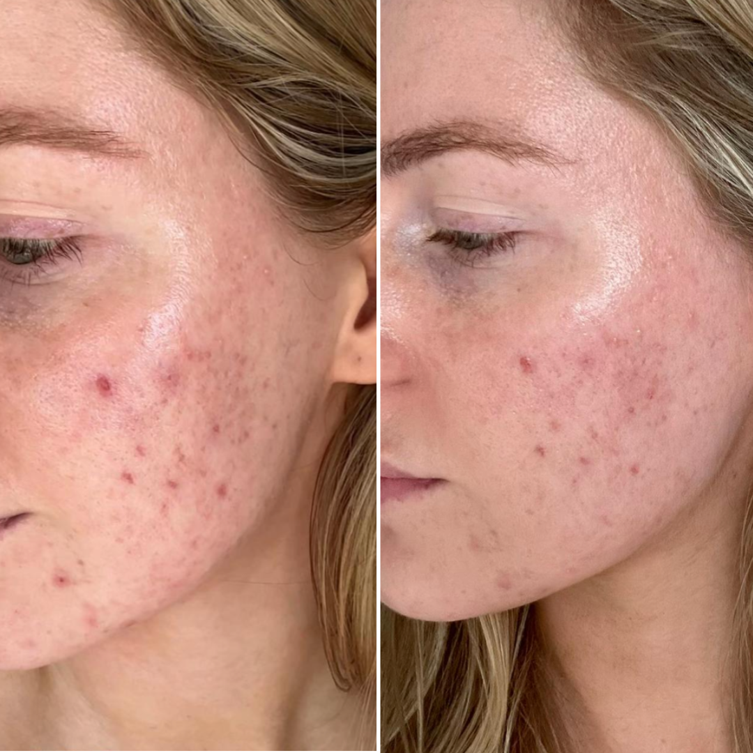 X8™ Microneedling Pen +30 Cartridges