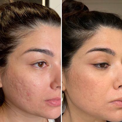 X8™ Microneedling Pen +30 Cartridges