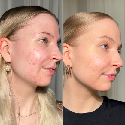 X8™ Microneedling Pen +30 Cartridges