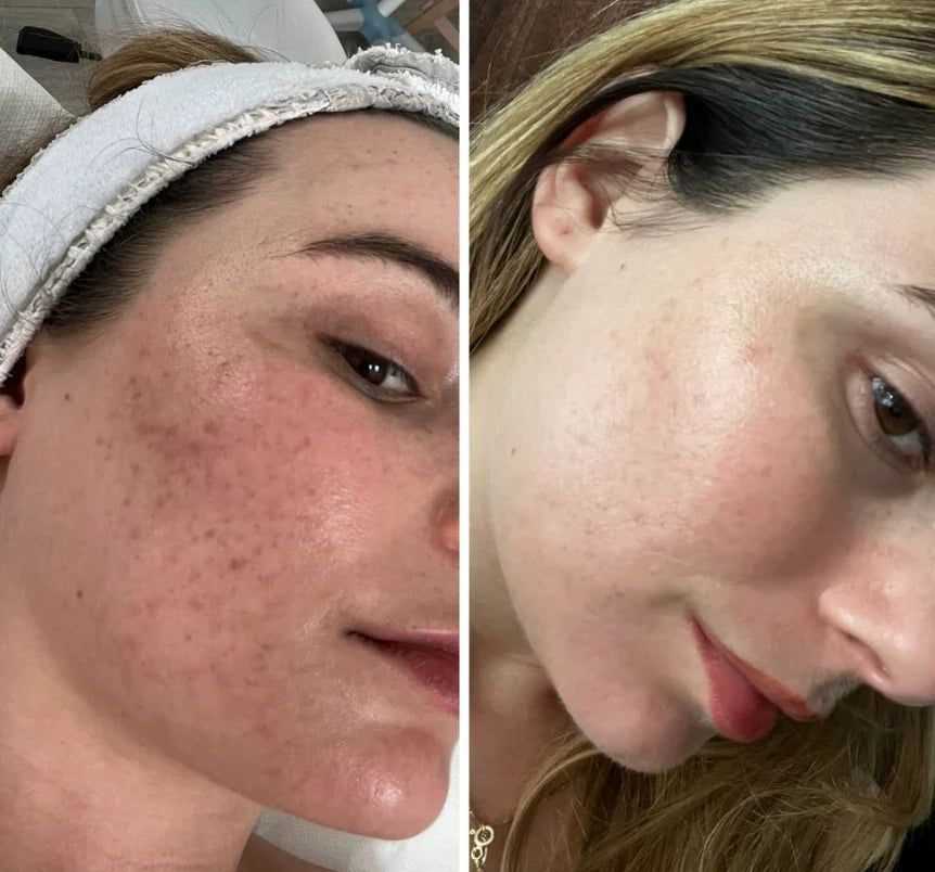 X8™ Microneedling Pen +30 Cartridges